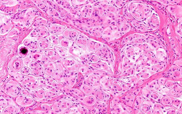 8A2 Meningioma, WHO I whorls (Case 8) H&E 1