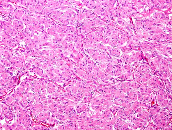 9A1 Meningioma, brain invasion (Case 9) H&E 1a 40x