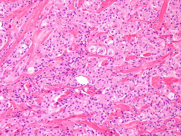 9A2 Meningioma (WHO-II, Case 9) H&E 11