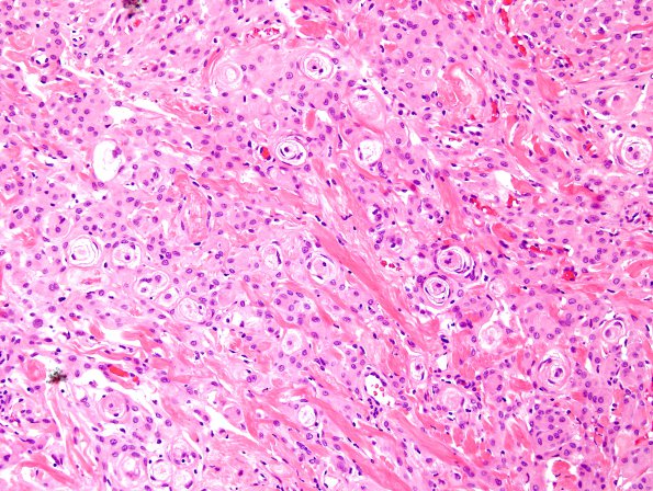 9A3 Meningioma (WHO-II, Case 9) H&E 12