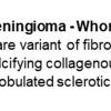 0A Meningioma - Whorling-Sclerosing - Text