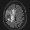 1A1 Meningioma, whorling sclerosing (Case 1) FLAIR 1 a - Copy