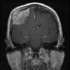 1A2 Meningioma, whorling sclerosing (Case 1) T1postgad 2 cor a - Copy