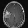 1A3 Meningioma, whorling sclerosing (Case 1) T1postgad a - Copy