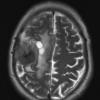 1A4 Meningioma, whorling sclerosing (Case 1) T2 a - Copy