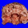 1B1 Meningioma, whorling sclerosing (Case 1) gross _1