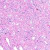 1C8 Meningioma, whorling sclerosing (Case 1) H&E 12