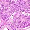 1C9 Meningioma, whorling sclerosing (Case 1) H&E 2