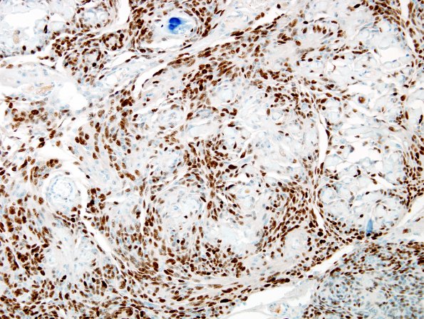 1E2 Meningioma, whorling sclerosing (Case 1) PR 4