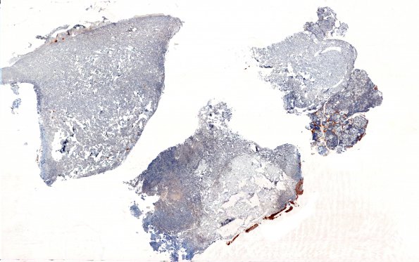 1F1 Meningioma, whorling sclerosing (Case 1) GFAP WM