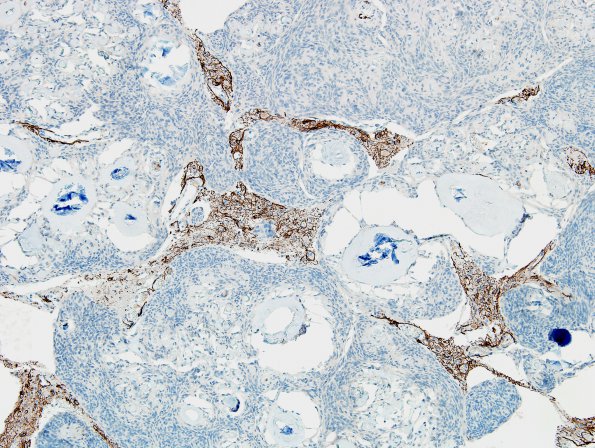 1F3 Meningioma, whorling sclerosing (Case 1) GFAP 5