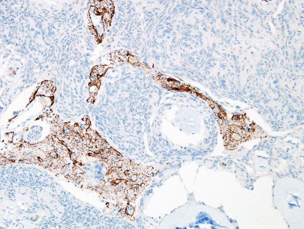 1F4 Meningioma, whorling sclerosing (Case 1) GFAP 2