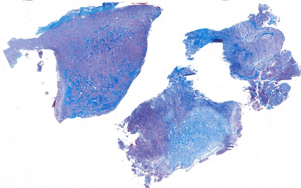 1G1 Meningioma, whorling sclerosing (Case 1) Trichrome WM