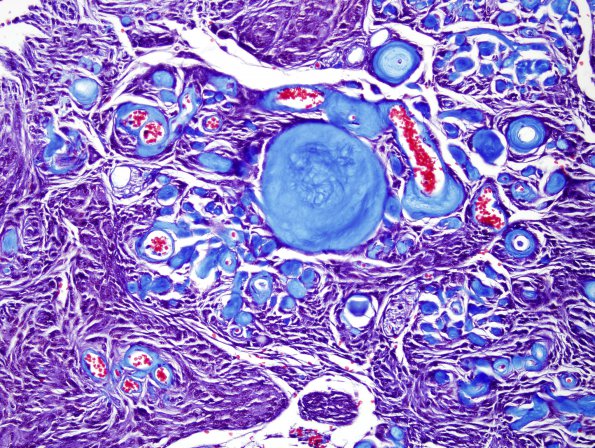 1G2 Meningioma, whorling sclerosing (Case 1) Trichrome 4