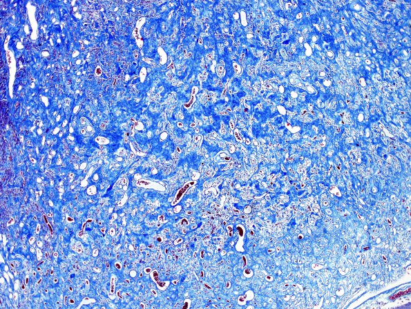 1G3 Meningioma, whorling sclerosing (Case 1) Trichrome 1