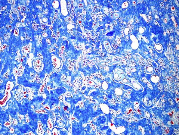 1G4 Meningioma, whorling sclerosing (Case 1) Trichrome 3