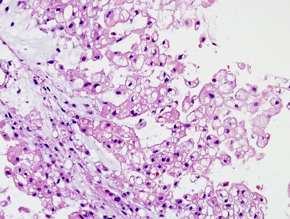  10A1 Chordoma (Case 10) H&E 7.jpg