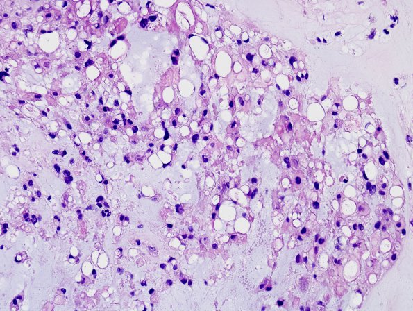 10A2 Chordoma (Case 10) H&E 9.jpg