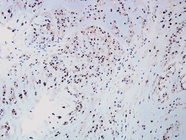 10B1 Chordoma (Case 10) Brachyury 1.jpg