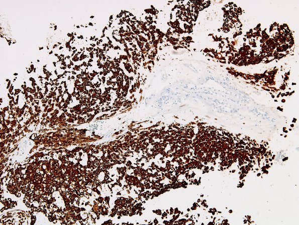 10C Chordoma (Case 10) PanKeratin 6.jpg