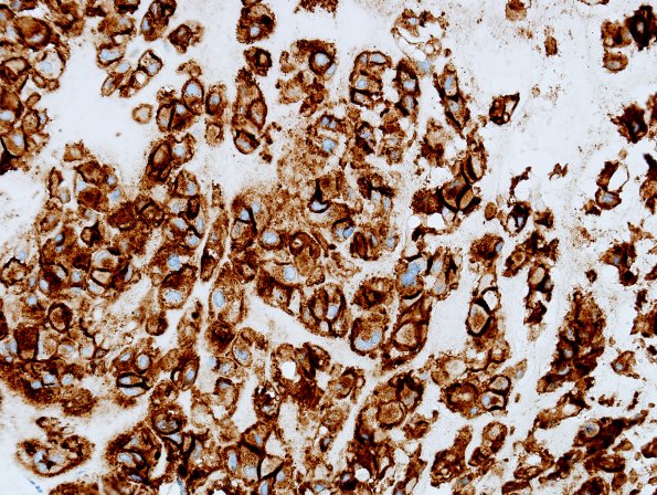 10D Chordoma (Case 10) EMA 2.jpg