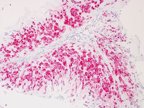 10E Chordoma (Case 10) S100 6.jpg