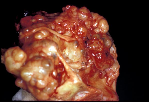 11A2 Chordoma (Case 11) 2