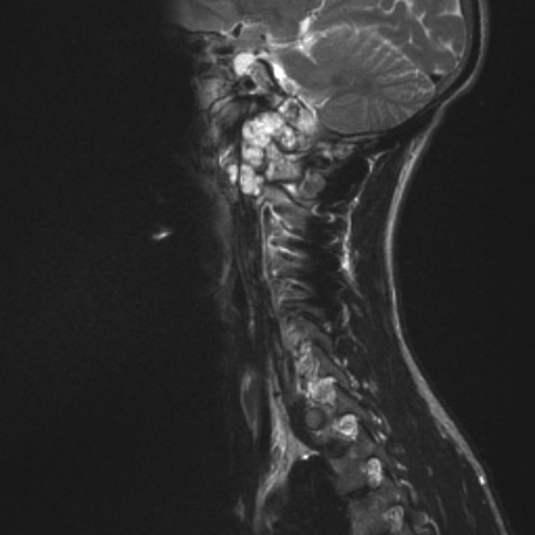 12A1 Chordoma (Case 12) T2 3 - Copy