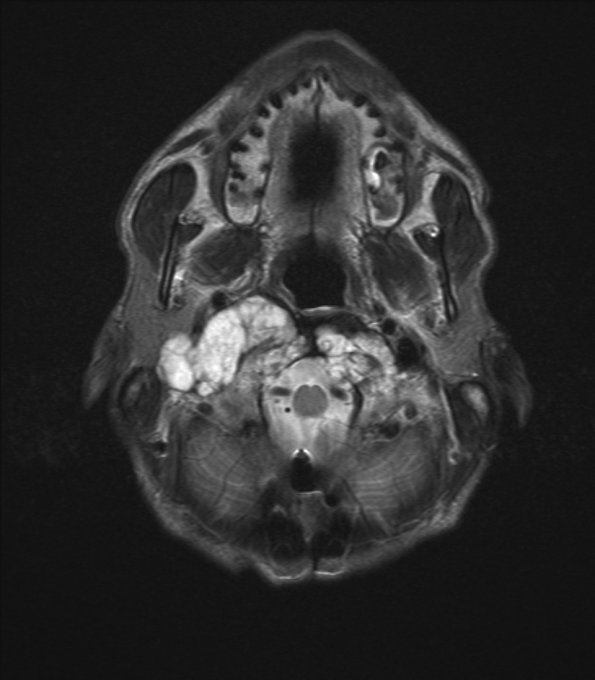 12A2 Chordoma (Case 12) T2 4 - Copy