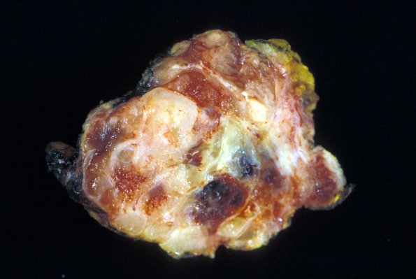 12B Chordoma (Case 12) D