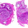 12C1 Chordoma (Case 12) A