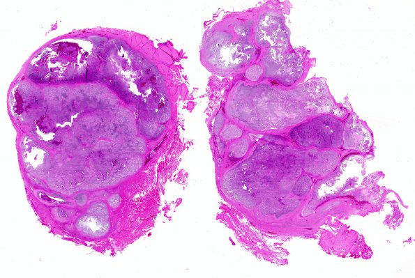 12C1 Chordoma (Case 12) A