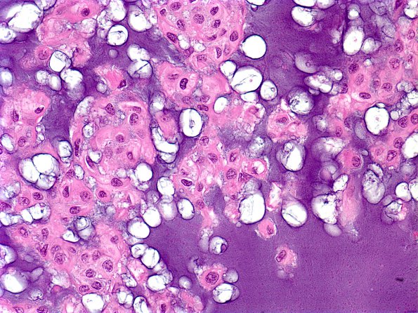 12C2 Chordoma (Case 12) B