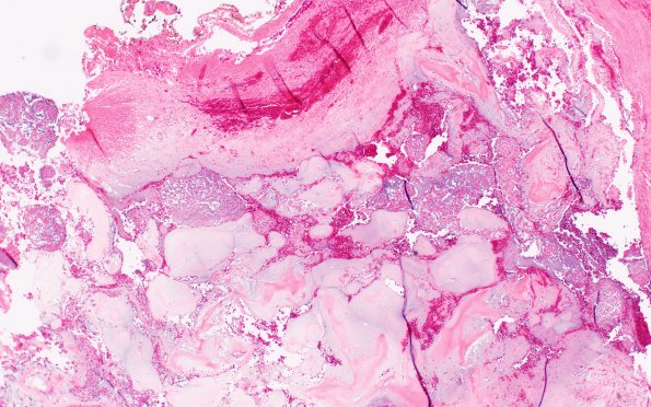 12C3 Chordoma (Case 12) A2 H&E 4X