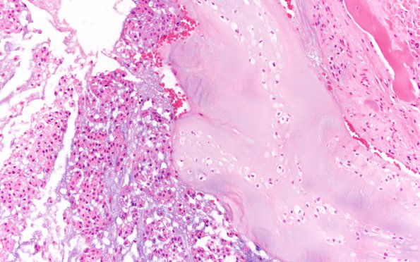 12C4 Chordoma (Case 12) A2 H&E 20X