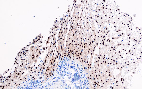 13B Chondroid chordoma (Case 13) Brachyury 1