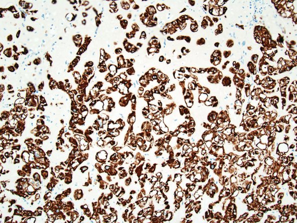 15C Chordoma, chondroid (Case 15) CK 1.jpg