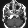 16A1 Chondrosarcoma, low grade (looks like chordoma, Case 16) T1 W 2 - Copy