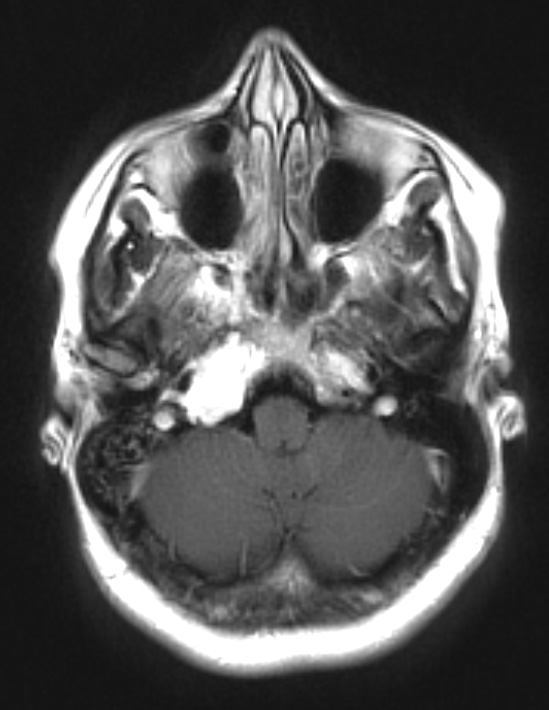 16A1 Chondrosarcoma, low grade (looks like chordoma, Case 16) T1 W 2 - Copy