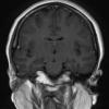 16A2 Chondrosarcoma, low grade (looks like chordoma, Case 16) T1 W 3 - Copy