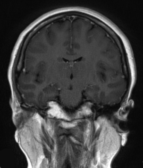 16A2 Chondrosarcoma, low grade (looks like chordoma, Case 16) T1 W 3 - Copy