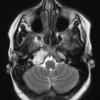 16A3 Chondrosarcoma, low grade (looks like chordoma, Case 16) T2 W 1 - Copy