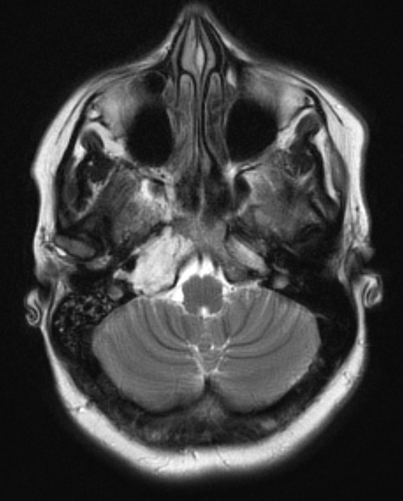 16A3 Chondrosarcoma, low grade (looks like chordoma, Case 16) T2 W 1 - Copy