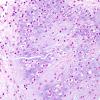 16B1 Chondrosarcoma, low grade (looks like chordoma, Case 16) H&E 2