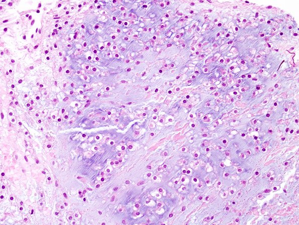 16B1 Chondrosarcoma, low grade (looks like chordoma, Case 16) H&E 2