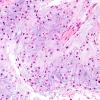 16B2  Chondrosarcoma, low grade (looks like chordoma, Case 16) H&E 4