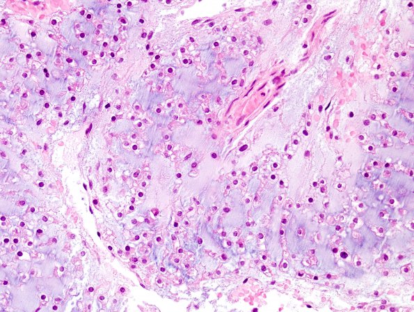 16B2  Chondrosarcoma, low grade (looks like chordoma, Case 16) H&E 4