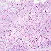 16B3 Chondrosarcoma, low grade (looks like chordoma, Case 16) H&E 8