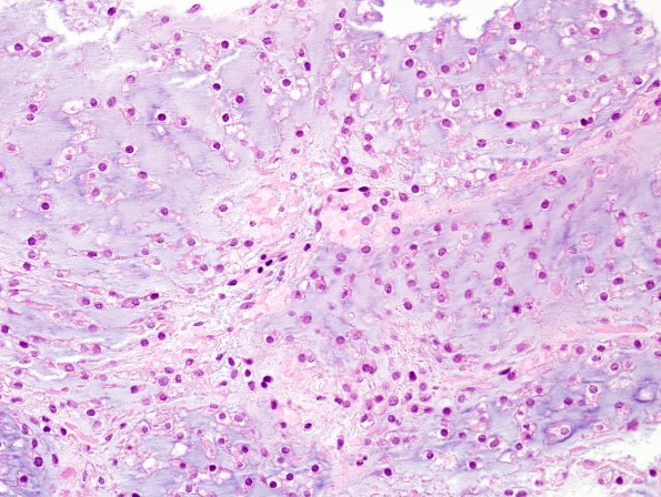 16B3 Chondrosarcoma, low grade (looks like chordoma, Case 16) H&E 8