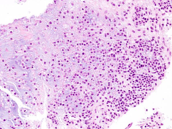 16B4 Chondrosarcoma, low grade (looks like chordoma, Case 16) H&E 9